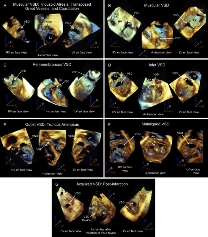 Echocardiogram of VSD